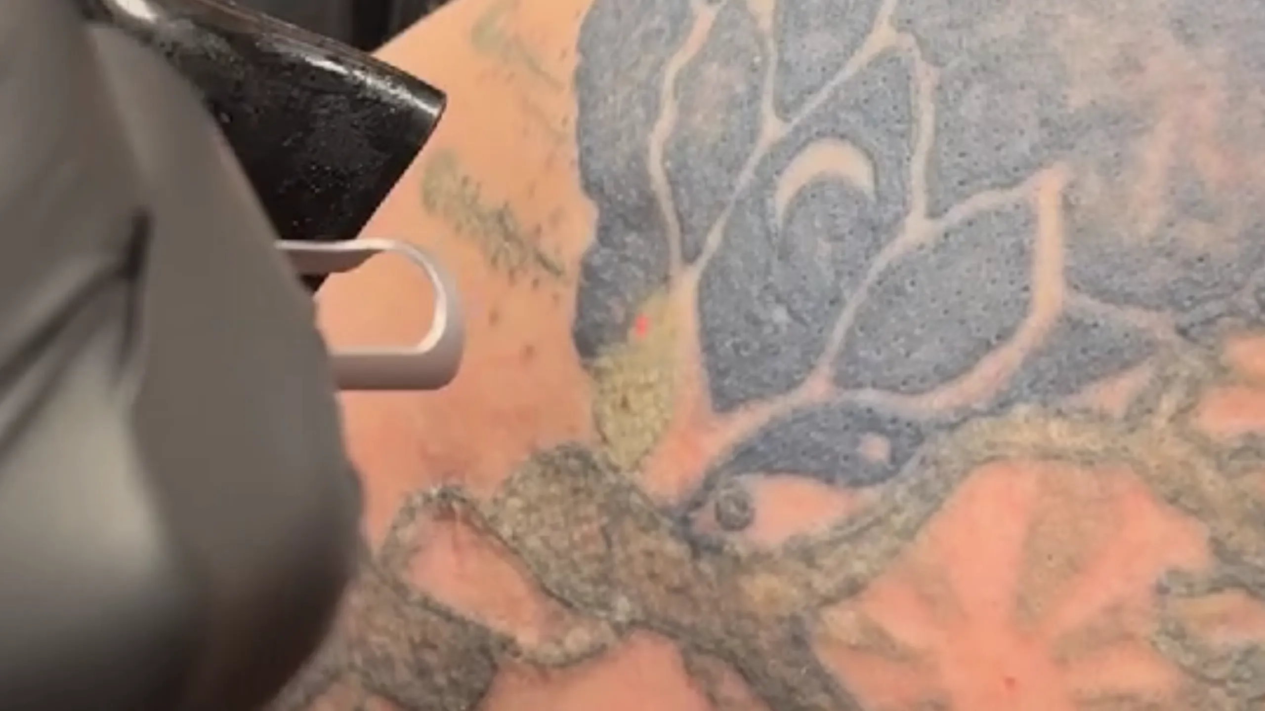Pico laser odstranjevanje tattooja med tretmajem