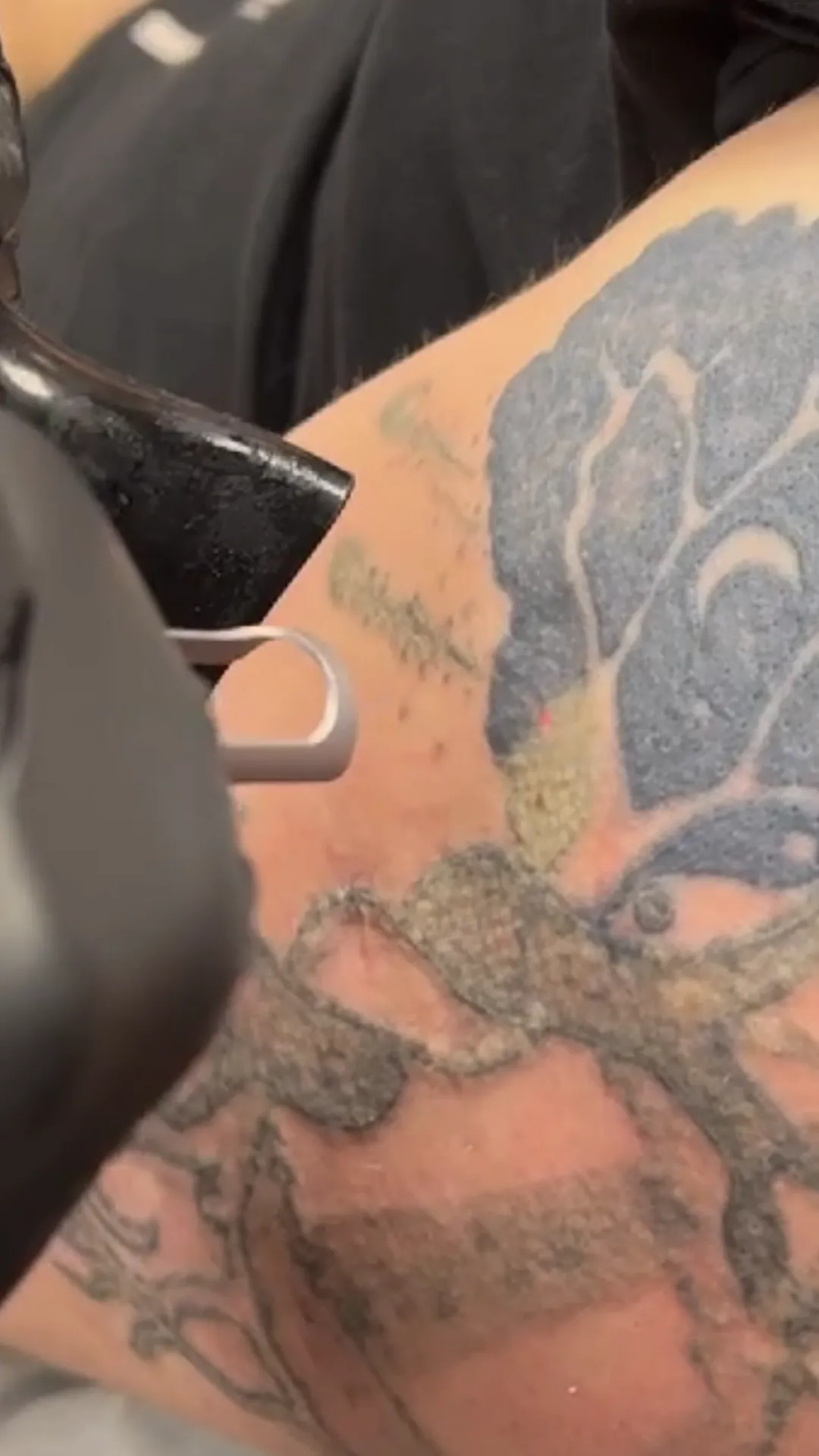 Pico laser odstranjevanje tattooja med tretmajem