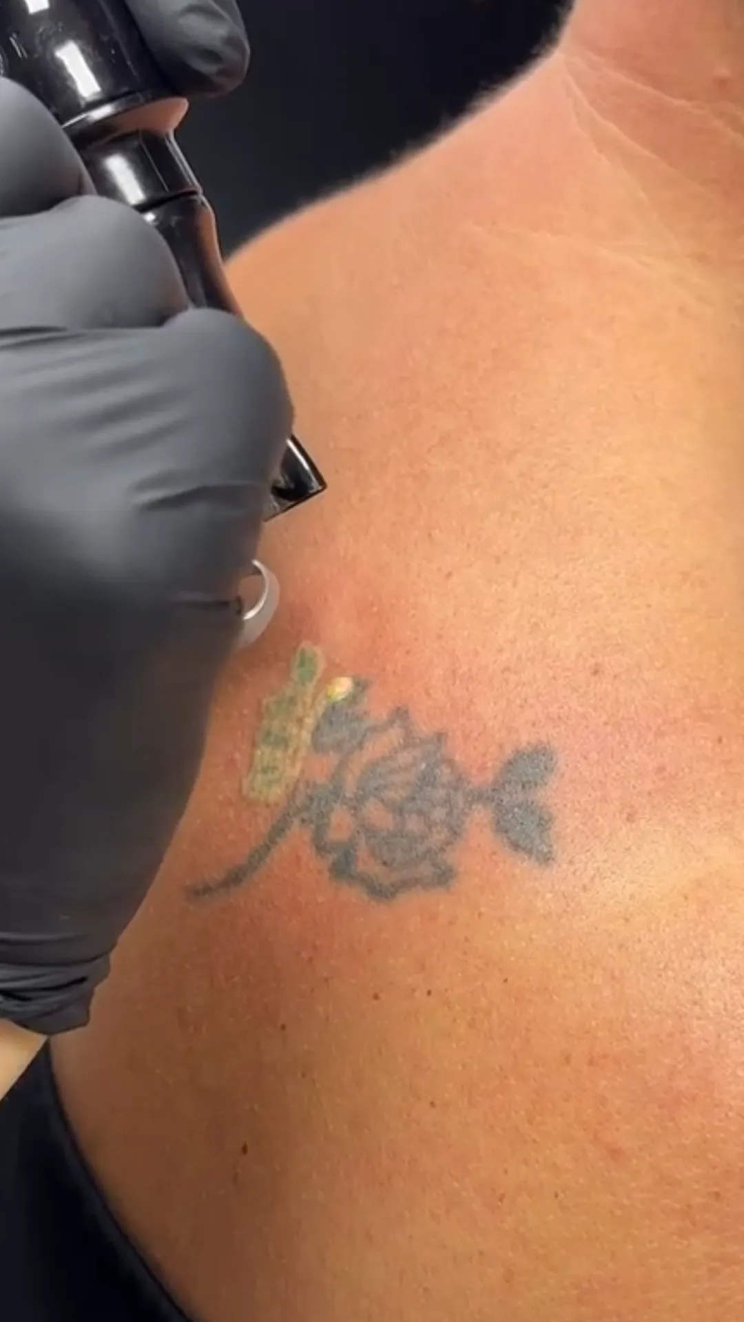 Pico laser med odstranjevanjem tattooja