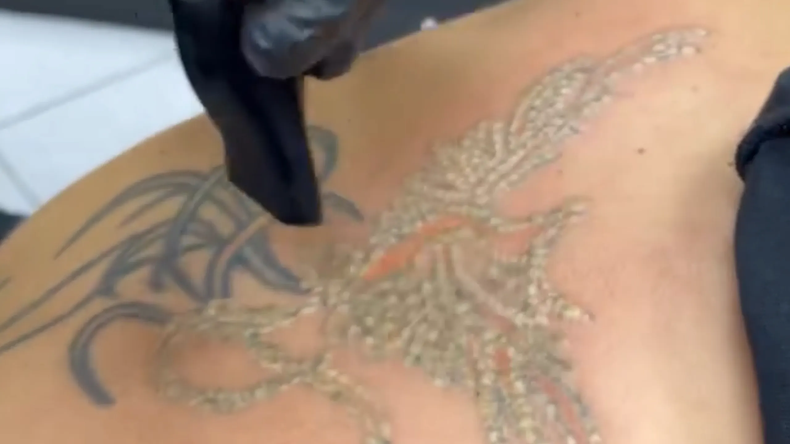 Hlajenje kože med odstranjevanjem tattooja