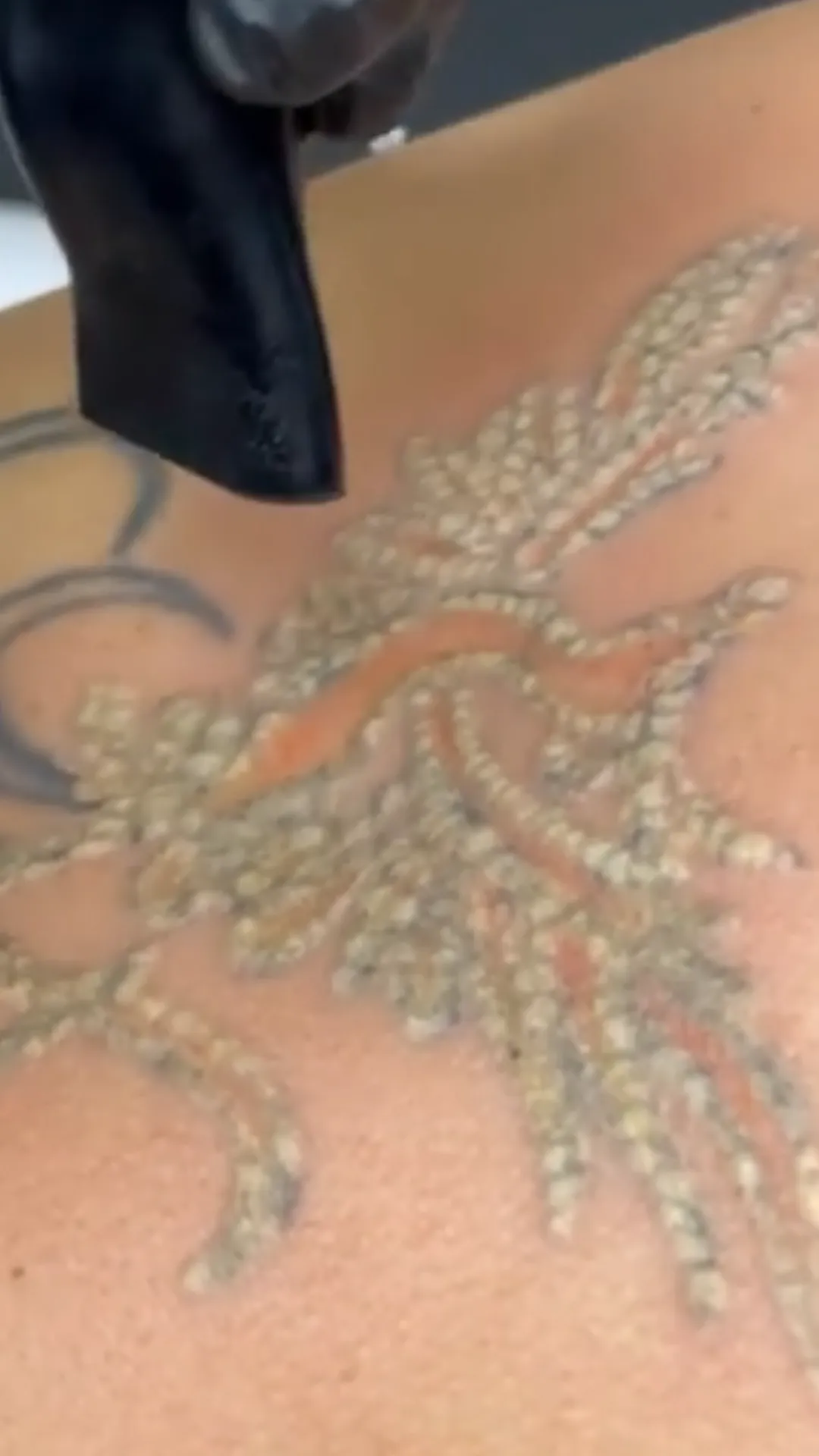 Hlajenje kože med odstranjevanjem tattooja
