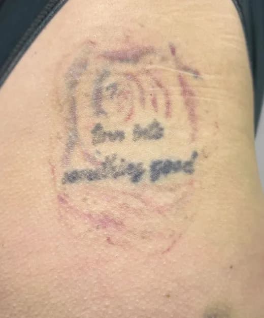 Barvni tattoo po štirih tretmajih laserskega odstranjevanja