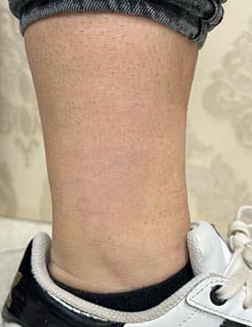 Manjši tattoo po laserskem odstranjevanju