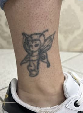 Manjši tattoo pred laserskim odstranjevanjem